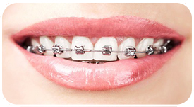 Tratamiento de ortodoncia con Brackets Metalicos en Tetuán