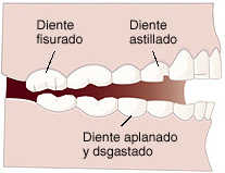 Bruxismo, Patologia de la ATM en clínica dental Tetuán
