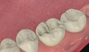 Empaste dental con composite o compuesto de resina, odontologia restauradora, tratamientos