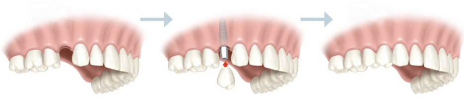 Corona sobre implante en clínica dental de Tetuán, Madrid