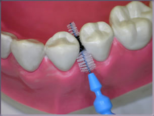 Cepillos interproximales para tratamiento de periodoncia en clínica dental Tetuán, Madrid