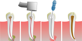 Endodoncia Uniradicular en dentista en Tetuán, odontologia conservadora, tratamientos